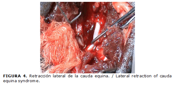 FIGURA 4. Retracción lateral de la cauda equina. / Lateral retraction of cauda equina syndrome.