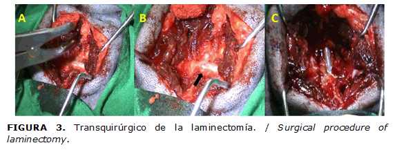 FIGURA 3. Transquirúrgico de la laminectomía. / Surgical procedure of laminectomy.