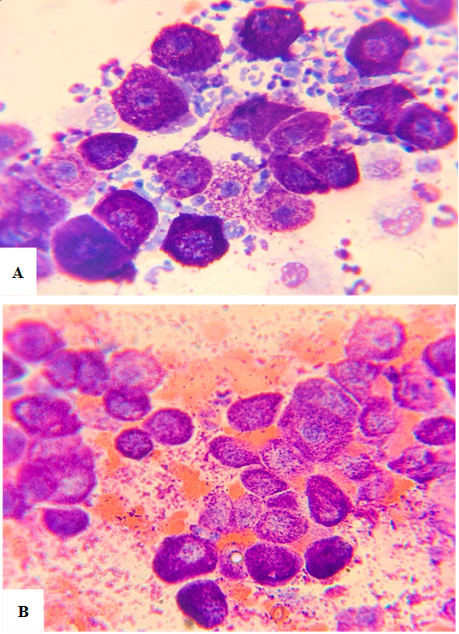 Cutaneous mast cell tumors from dogs. A. Sample with moderate amount of mast cells, neoplastic nuclei are stained light blue, some of the two with prominent nucleoli, moderate cytoplasm with purplish granules. There is also the presence of inflammatory infiltration with the presence of neutrophils and macrophages, lens 100. B. Aspirate from two well-differentiated cutaneous mast cell tumors from two dogs. Sample with moderate amount of uniform and well-differentiated neoplastic cells, noting the nuclei almost obscured by the presence of several coarse purplish granules (panopticon colors), lens 100 (Author's original). / Tumores cutáneos de mastocitos en perros. A. Muestra con cantidad moderada de mastocitos; los núcleos neoplásicos se tiñen de azul claro, algunos de ellos con nucléolos prominentes, y citoplasma moderado con gránulos violáceos. También se observa infiltración inflamatoria con presencia de neutrófilos y macrófagos, aumento 100x. B. Aspirado de dos tumores cutáneos de mastocitos bien diferenciados de dos perros. Muestra con cantidad moderada de células neoplásicas uniformes y bien diferenciadas, observándose los núcleos casi oscurecidos por la presencia de numerosos gránulos gruesos violáceos (coloración pancrómica), aumento 100x (Original del autor).